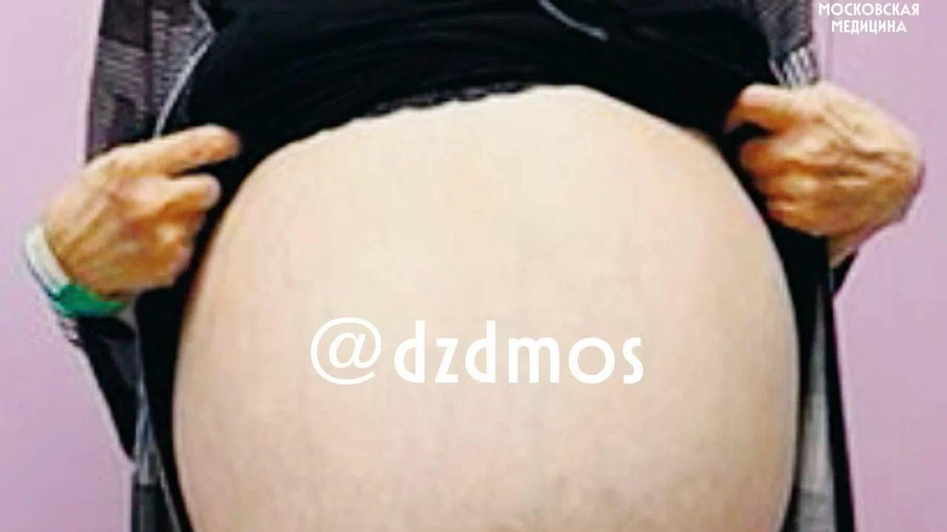 В столичной больнице имени С. С. Юдина пациентке удалили огромную опухоль яичника - РИА Новости, 1920, 10.12.2025