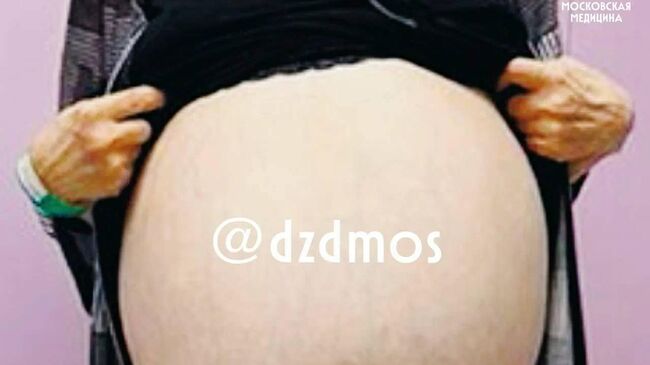 В столичной больнице имени С. С. Юдина пациентке удалили огромную опухоль яичника