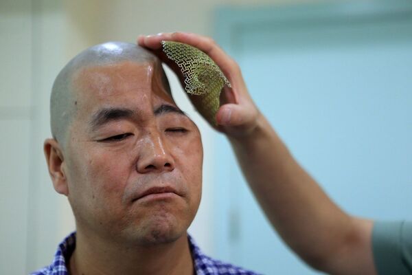 Китайцу восстановили череп с помощью протеза, напечатанного на 3D принтере