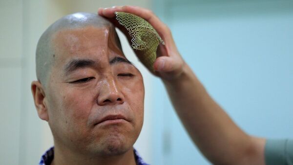Китайцу восстановили череп с помощью протеза напечатанного на 3D принтере