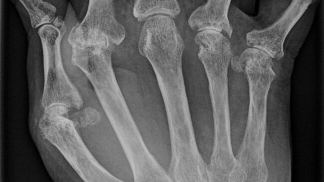 Рентген руки человека, страдающей от артрита Рентген руки человека, страдающей от артрита