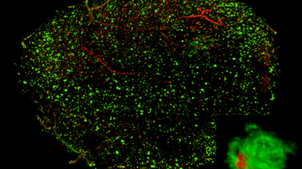 Бляшки бета-амилоида (показаны красным цветом), возникшие в мозге людей с болезнью Альцгеймера