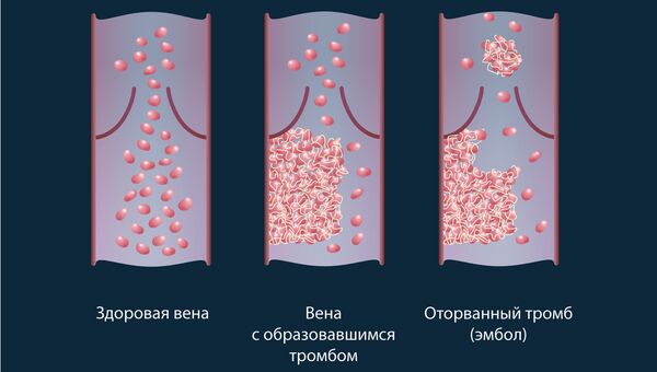 Схема движения клеток с красителем в здоровых сосудах и сосудах с тромбами