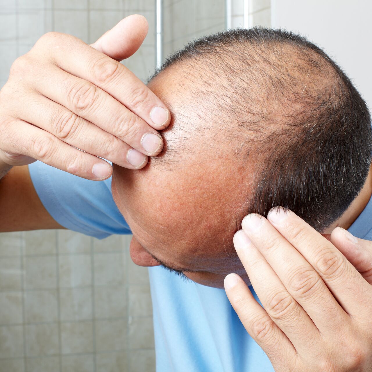 Пересадка волос на голове: где делают операцию и как происходит процедура