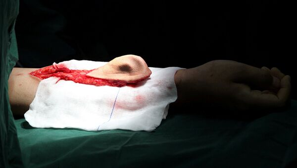 Ухо, растущее на руке пациента, перед операцией по пересадке в городе Сиань, провинция Шэньси, Китай. 29 марта 2017