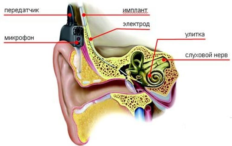 Схема установки кохлеарного импланта 