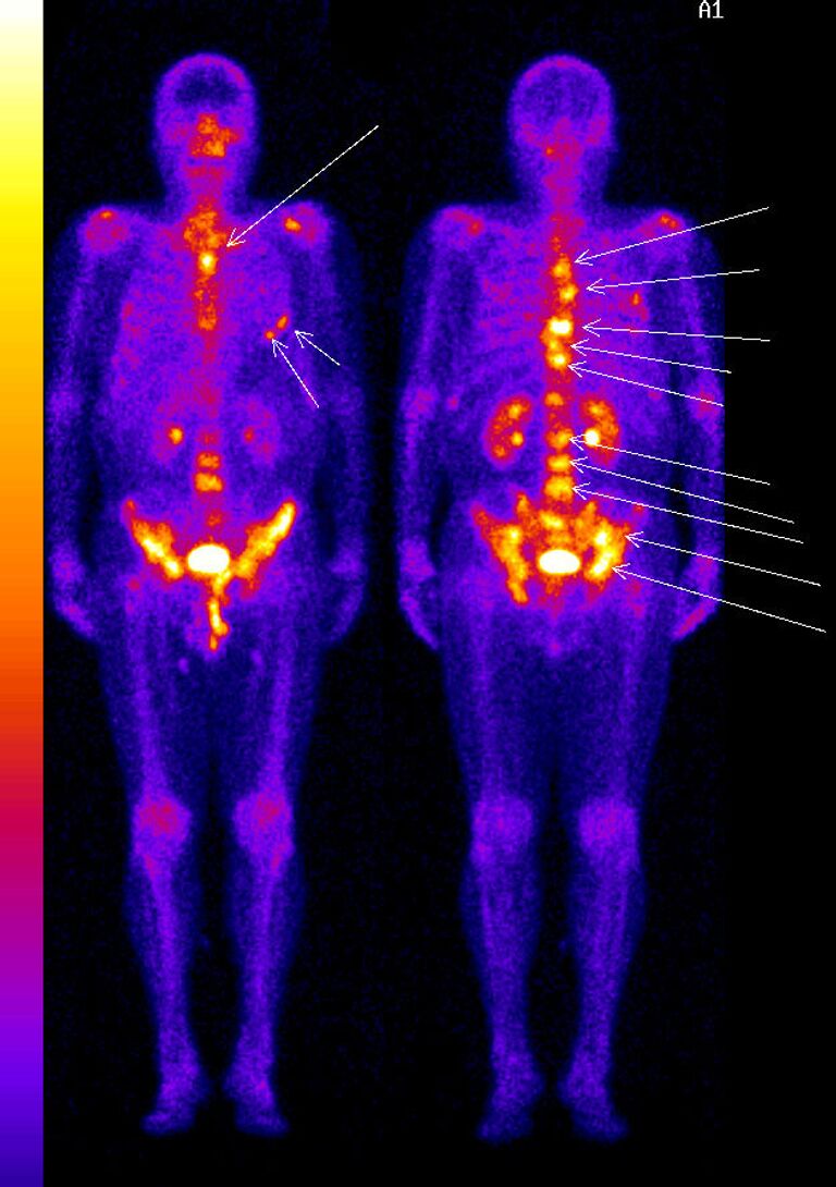 Рфп в медицине в онкологии это что. Рфп в медицине в онкологии это что. Рфп в медицине в онкологии это что. Рфп в медицине в онкологии это что. Рфп в медицине в онкологии это что.