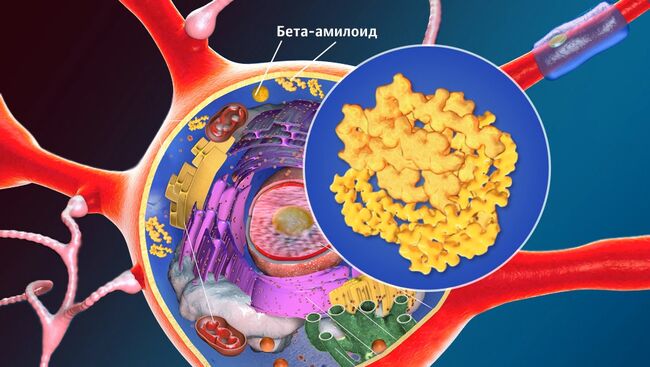 Бляшки бета-амилоида в нервной клетке