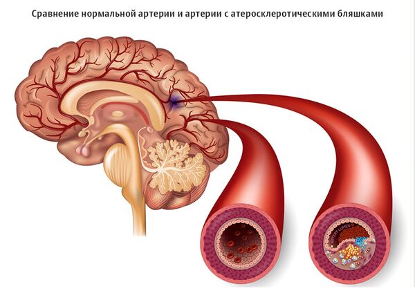 Сравнение здоровой артерии и артерии с атеросклеротическими бляшками, образование которых может привести к инсульту Сравнение здоровой артерии и артерии с атеросклеротическими бляшками, образование которых может привести к инсульту