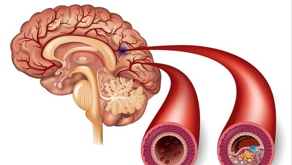 Сравнение здоровой артерии и артерии с атеросклеротическими бляшками, образование которых может привести к инсульту