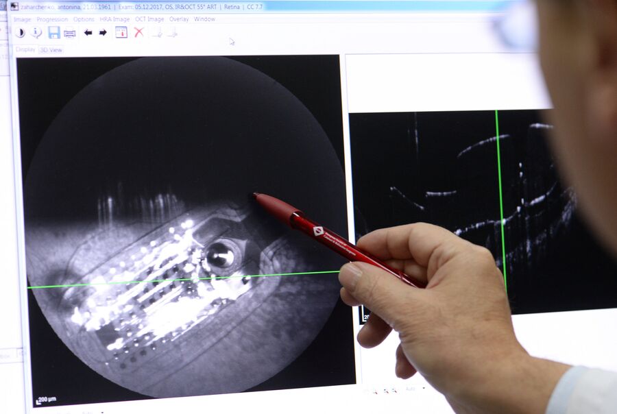 Директор НИЦ РНИМУ имени Пирогова, профессор Христо Тахчиди изучает изображение на мониторе после операции по установке ретинального импланта (протез сетчатки) пациенту