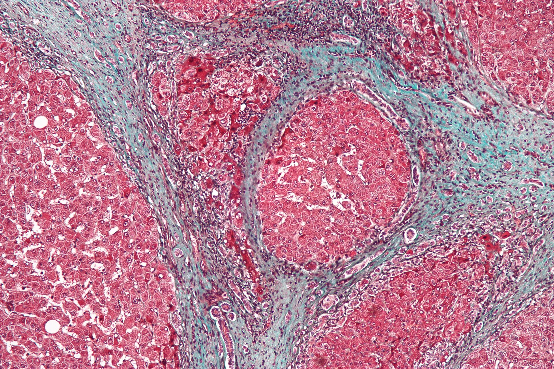 Микрофотография печени, пораженной циррозом, - болезни, часто возникающей при злоупотреблении алкоголем - РИА Новости, 1920, 24.12.2022