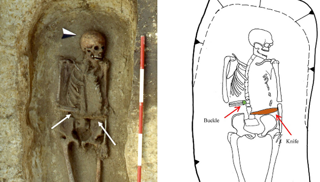 Останки мужчины времен раннего средневековья, который прикрепил себе нож на место ампутированной руки