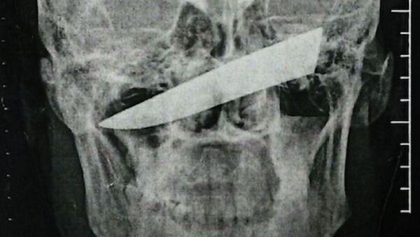 Рентгеновский снимок черепа человека с лезвием ножа после нападения в Южной Африке