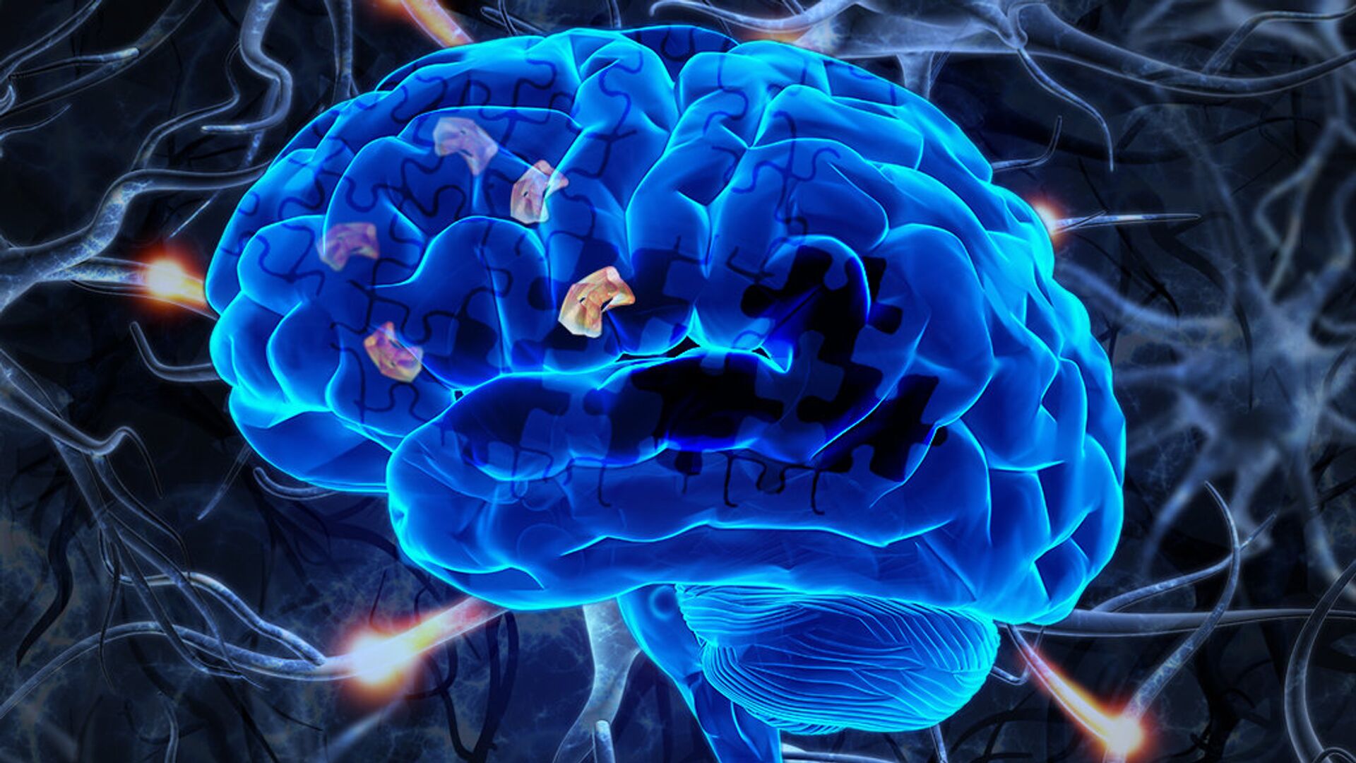 Ученые назвали признак риска кровоизлияния в мозг