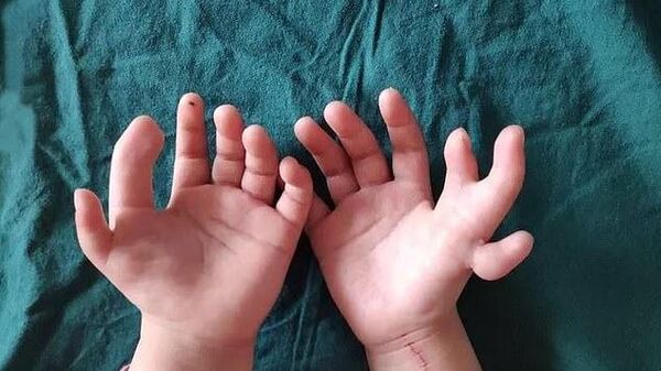 Руки девочки, родившейся с 14 пальцами перед операцией в Центральной больнице Шеньянского медицинского колледжа