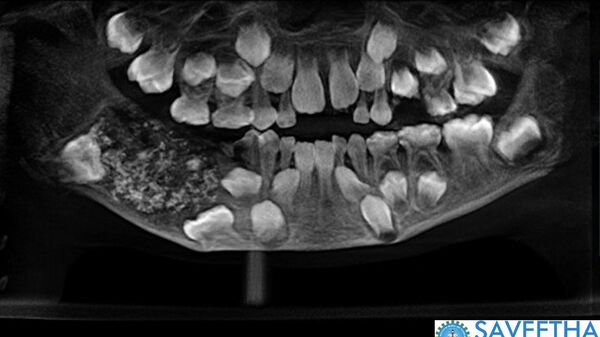 Зубы во рту 7 летнего мальчика из Индии, пациента Saveetha Dental College and Hospital