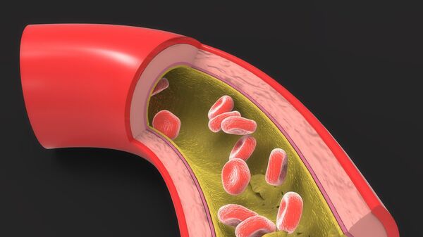 Пораженная артерия с жировыми отложениями