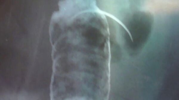 Рентгеновский снимок, на котором видна игла, которую врачи, когда-то удалявшие аппендикс Николаю, забыли в животе 