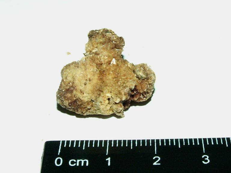 Почечный камень Почечный камень