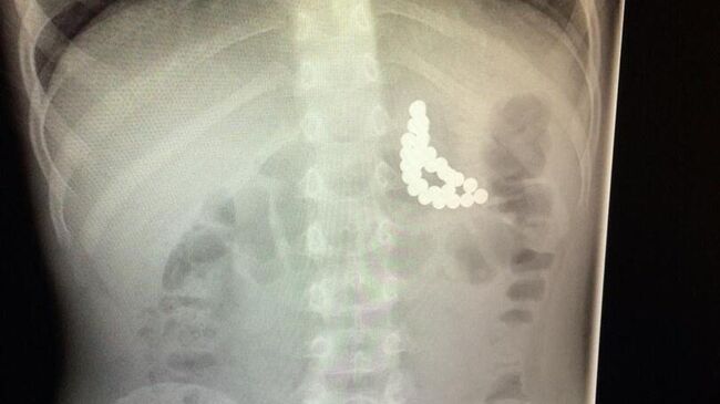 Врачи детской больницы скорой помощи в Томске спасли ребенка, проглотившего 31 магнитный шарик