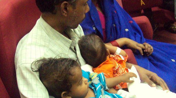 Операция по разделению сиамских близнецов в Индии