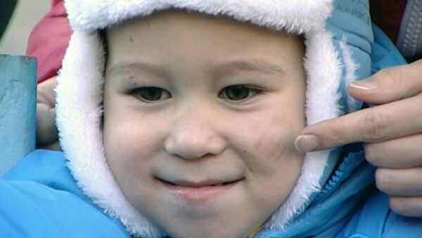 Мать двухлетнего Ростислава показала искусанное в детсаду лицо сына