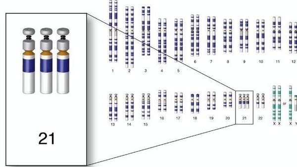 Хромосомный набор человека с трисомией по 21-й хромосоме