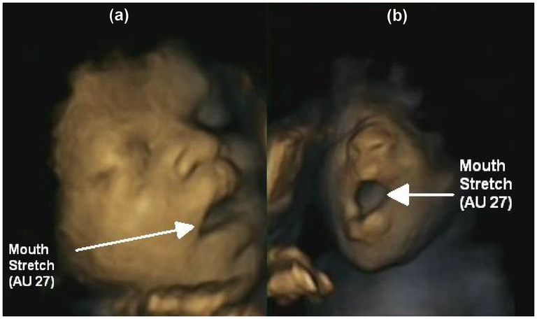 Зевающие младенцы в утробе матери