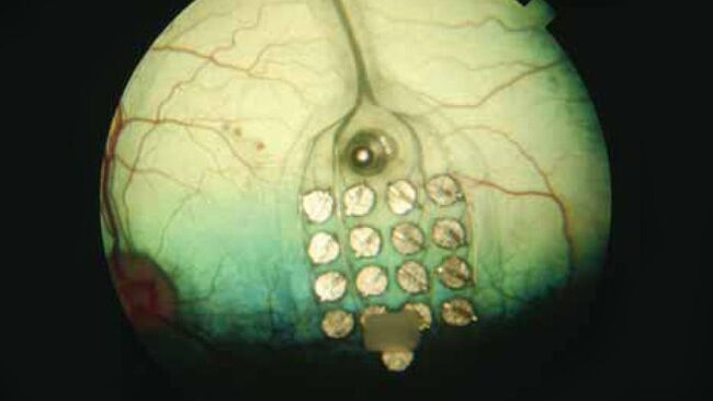 Матрица электродов, вживленных в сетчатку глаза