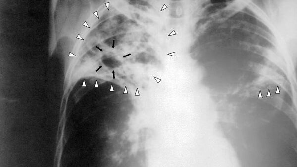 Рентгенограмма органов грудной клетки больного туберкулёзом легких с распадом