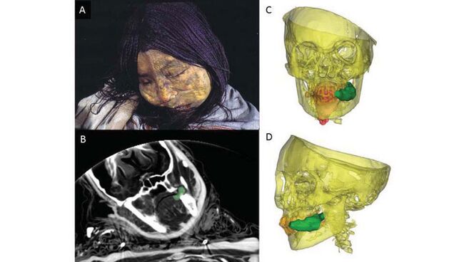 Мумия “ледяной принцессы”, найденная на склонах вулкана Льюльяйльяко. Зеленое пятно – жвачка из листьев коки