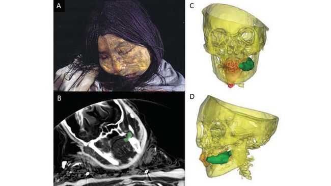 Мумия “ледяной принцессы”, найденная на склонах вулкана Льюльяйльяко. Зеленое пятно – жвачка из листьев коки
