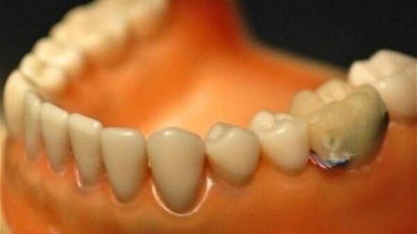 Зуб с акселерометром внутри отслеживает движения челюстей при жевании, питье, говорении и кашле
