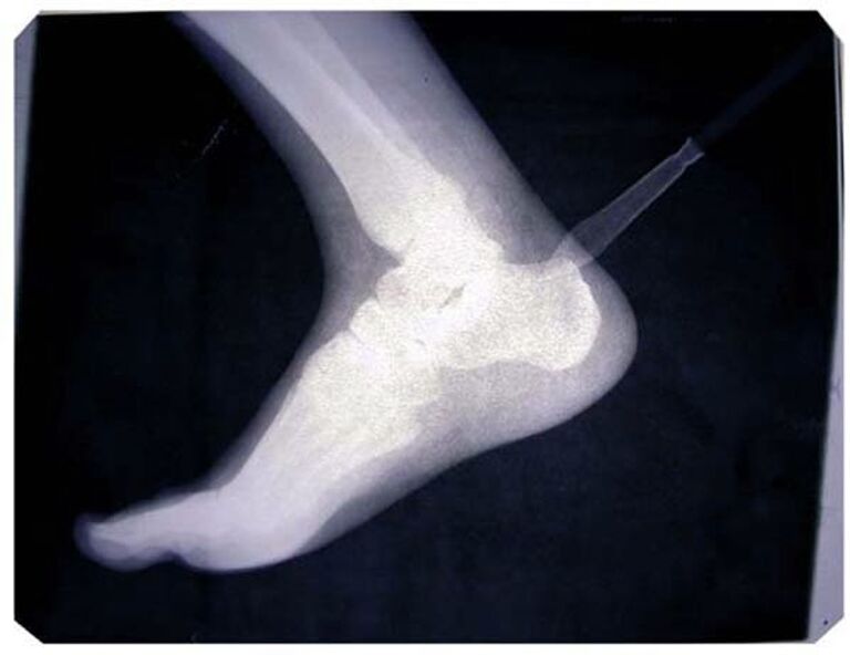 Василий Слонов. Ахилл. Из проекта Друзья детства 1999 – 2013. Рентгенографика. Василий Слонов. Ахилл. Из проекта Друзья детства 1999 – 2013. Рентгенографика.