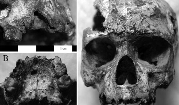 Следы инфекционных заболеваний на черепе из древнего города Хараппы
