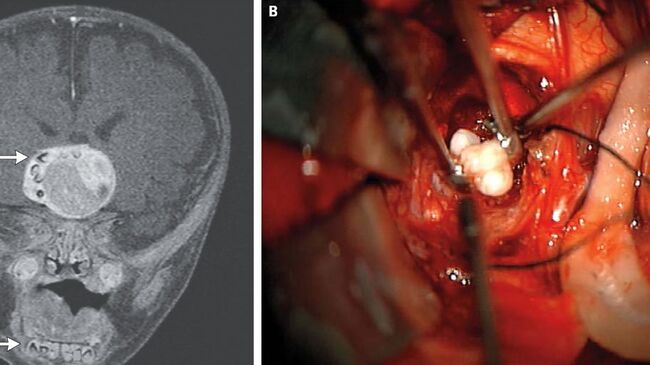 Медики обнаружили зубы, образовавшиеся в опухоли в мозгу младенца