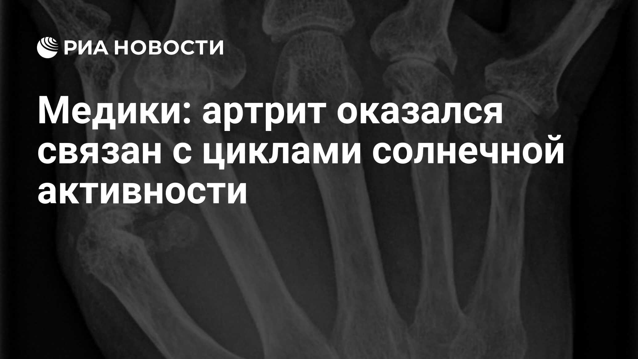 Медики: артрит оказался связан с циклами солнечной активности - РИА  Новости, 16.06.2015