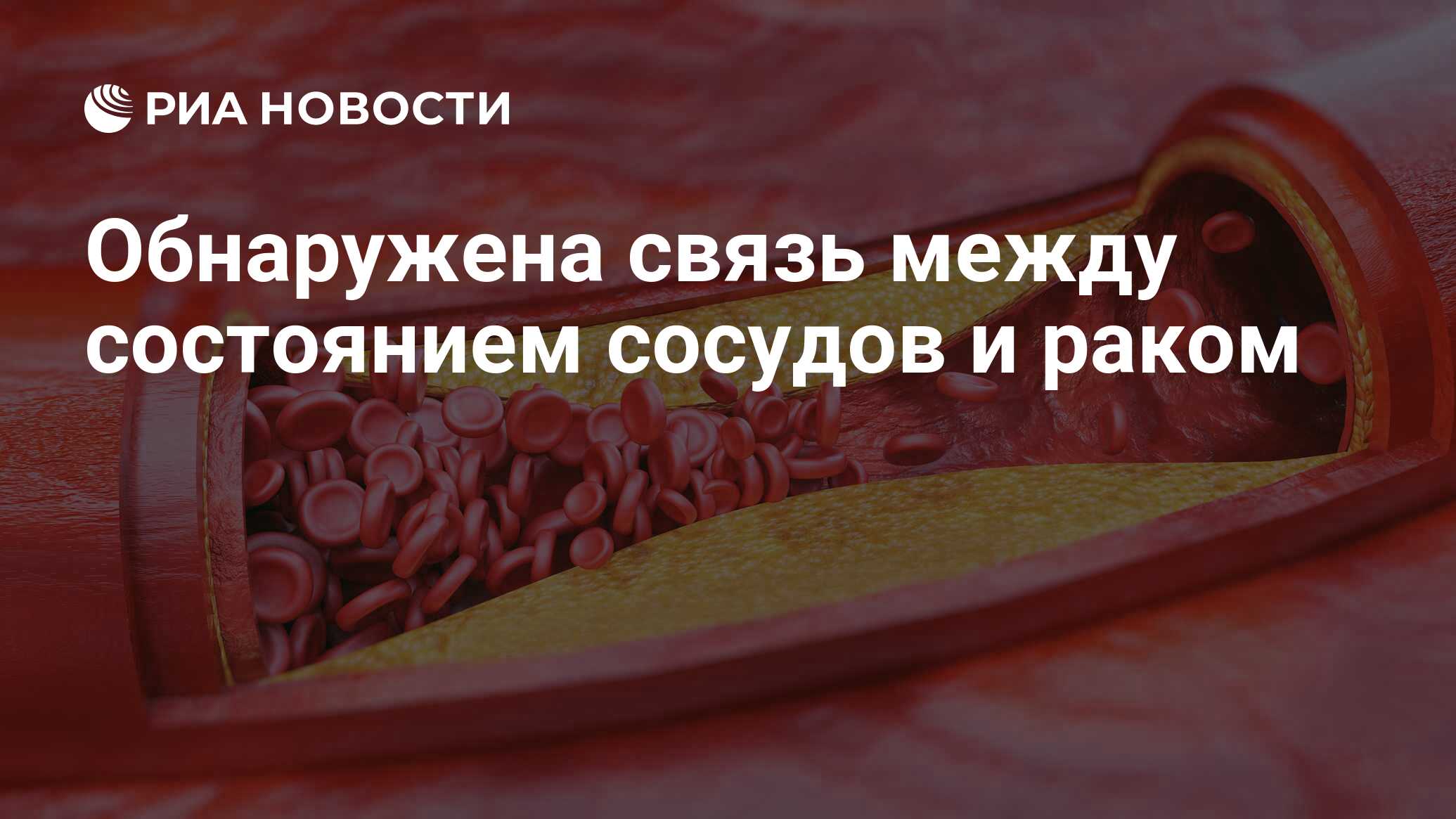 Обнаружена связь между состоянием сосудов и раком - РИА Новости, 31.10.2019