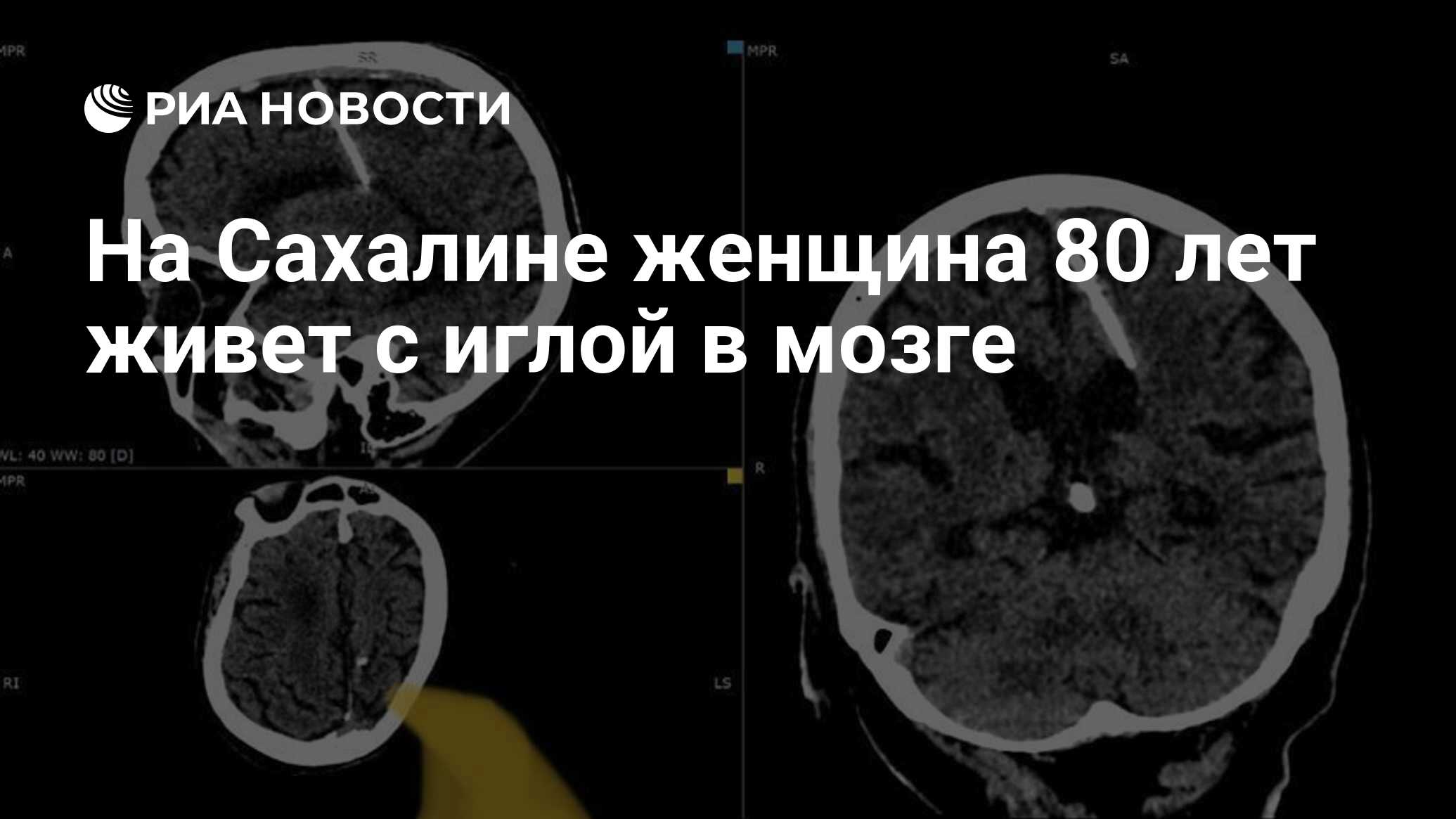 На Сахалине женщина 80 лет живет с иглой в мозге - РИА Новости, 04.10.2023