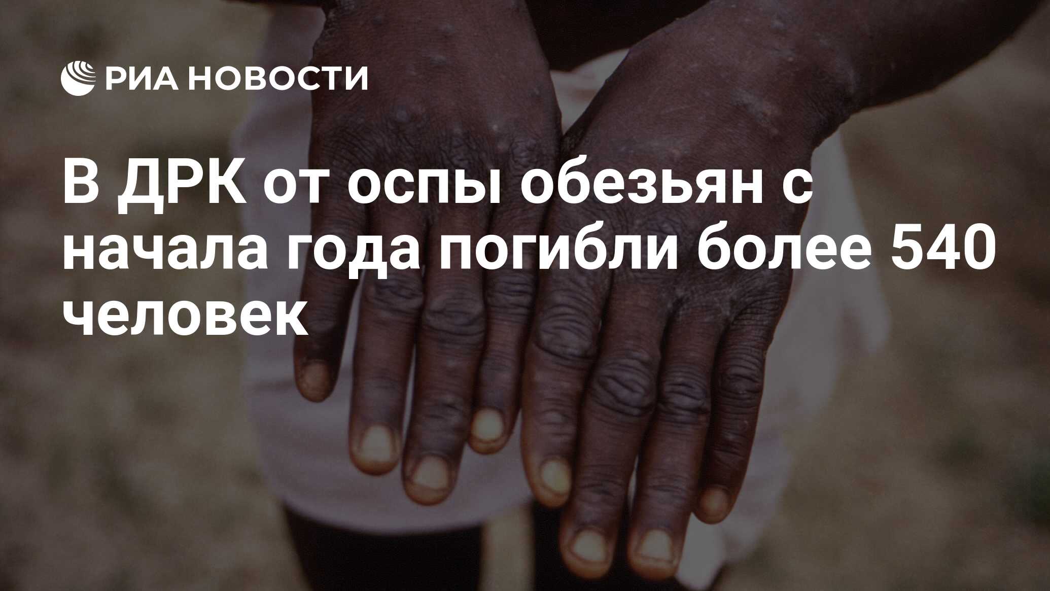 Можно ли вылечиться от оспы обезьян. Можно ли вылечиться от оспы обезьян